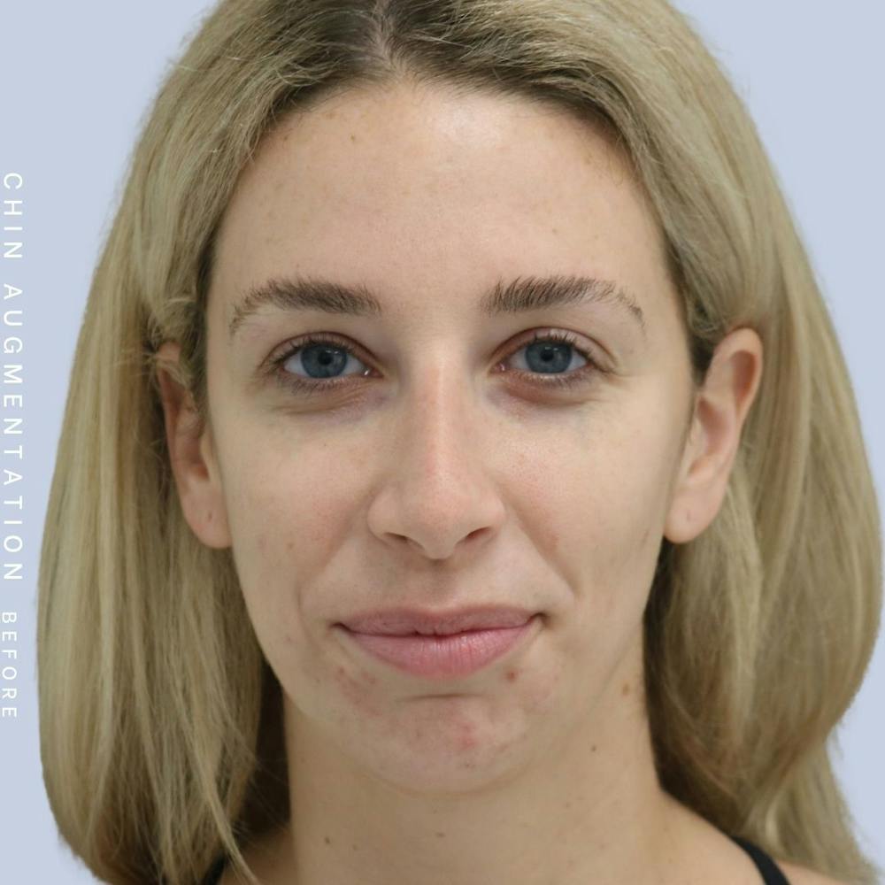 Nose Before & After Gallery - Patient 108744867 - Image 1