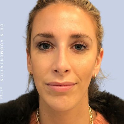 Nose Before & After Gallery - Patient 108744867 - Image 2