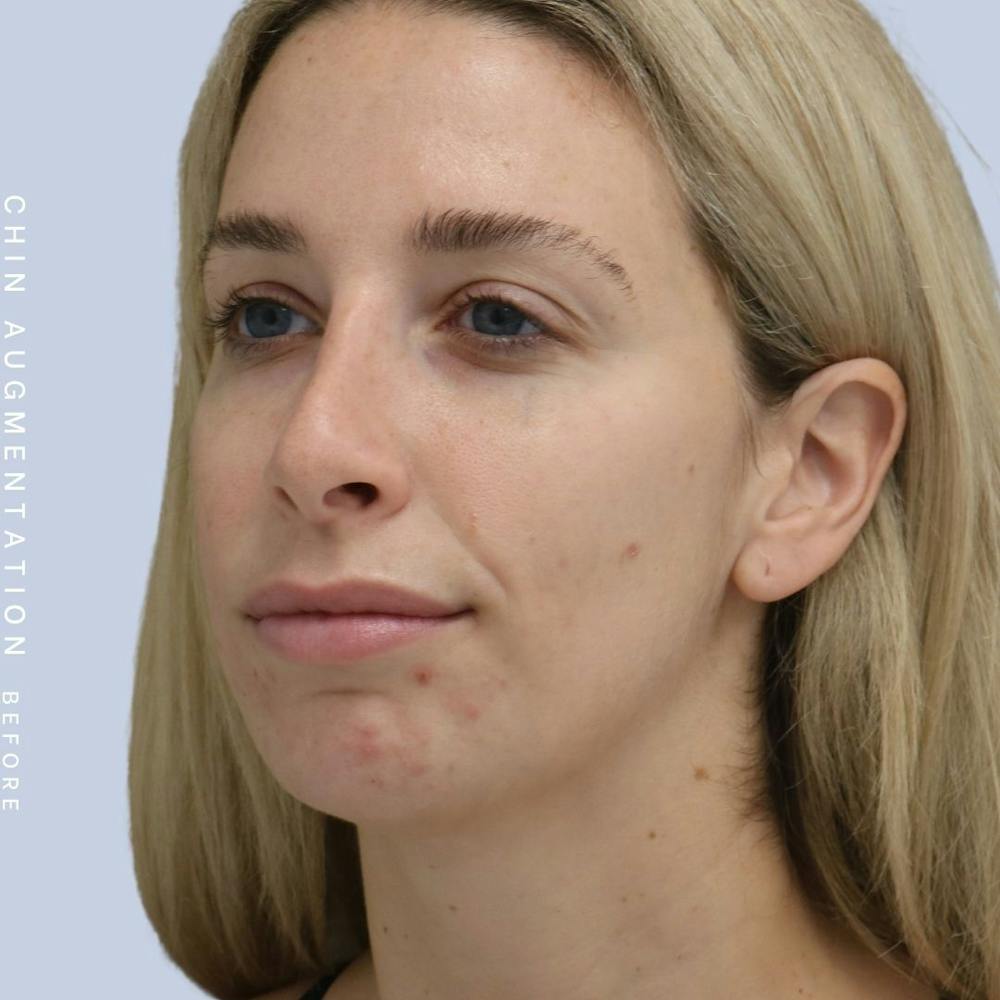 Nose Before & After Gallery - Patient 108744867 - Image 3
