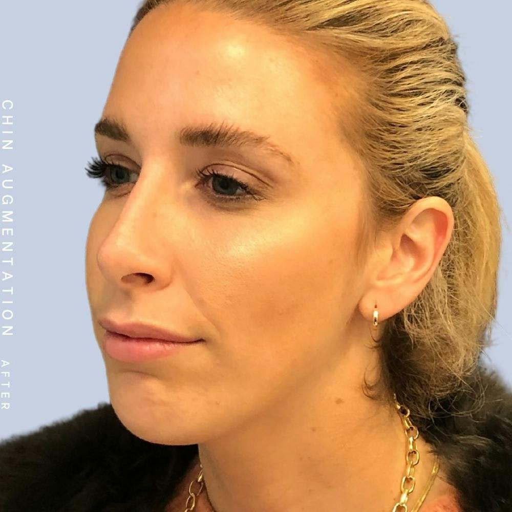 Nose Before & After Gallery - Patient 108744867 - Image 4