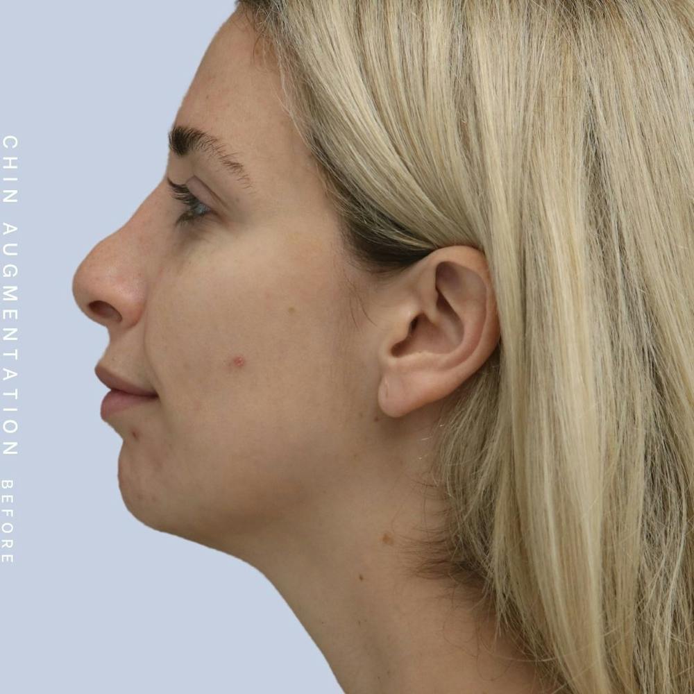 Nose Before & After Gallery - Patient 108744867 - Image 5