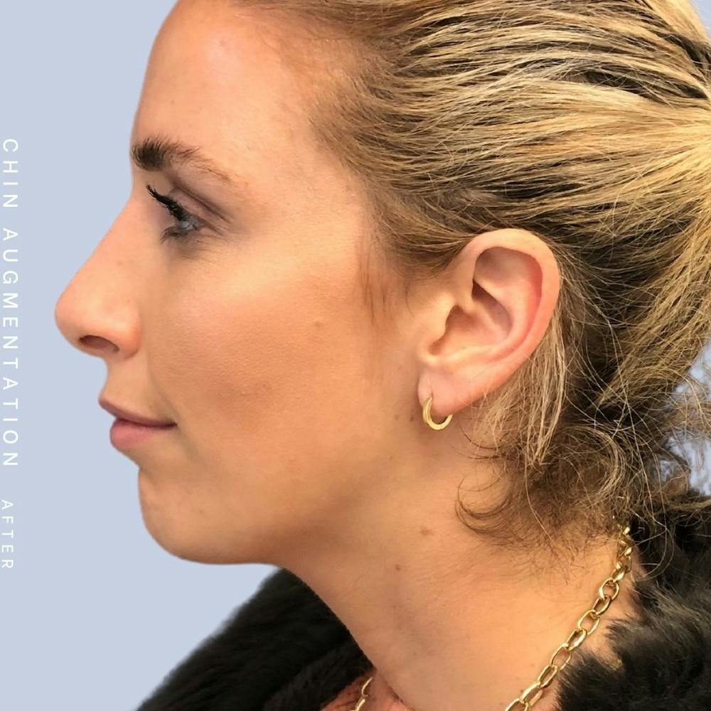 Nose Before & After Gallery - Patient 108744867 - Image 6