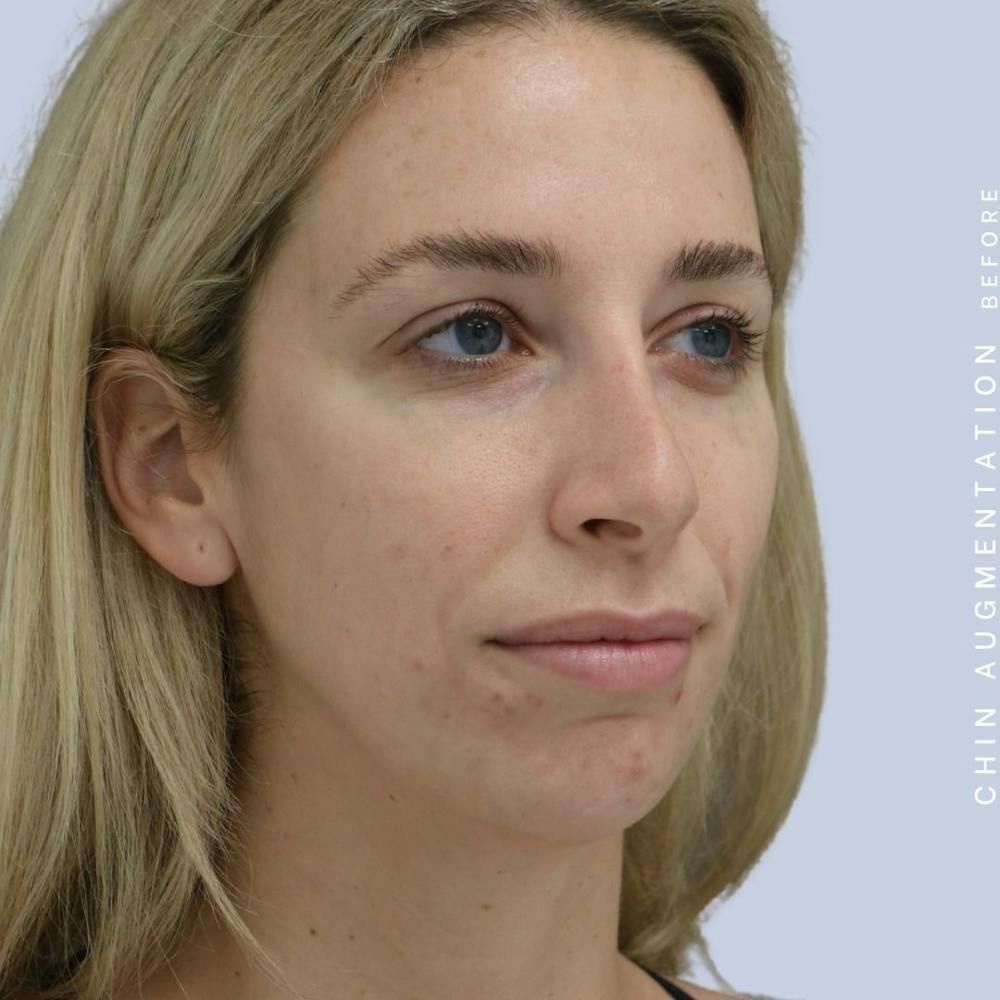 Nose Before & After Gallery - Patient 108744867 - Image 7