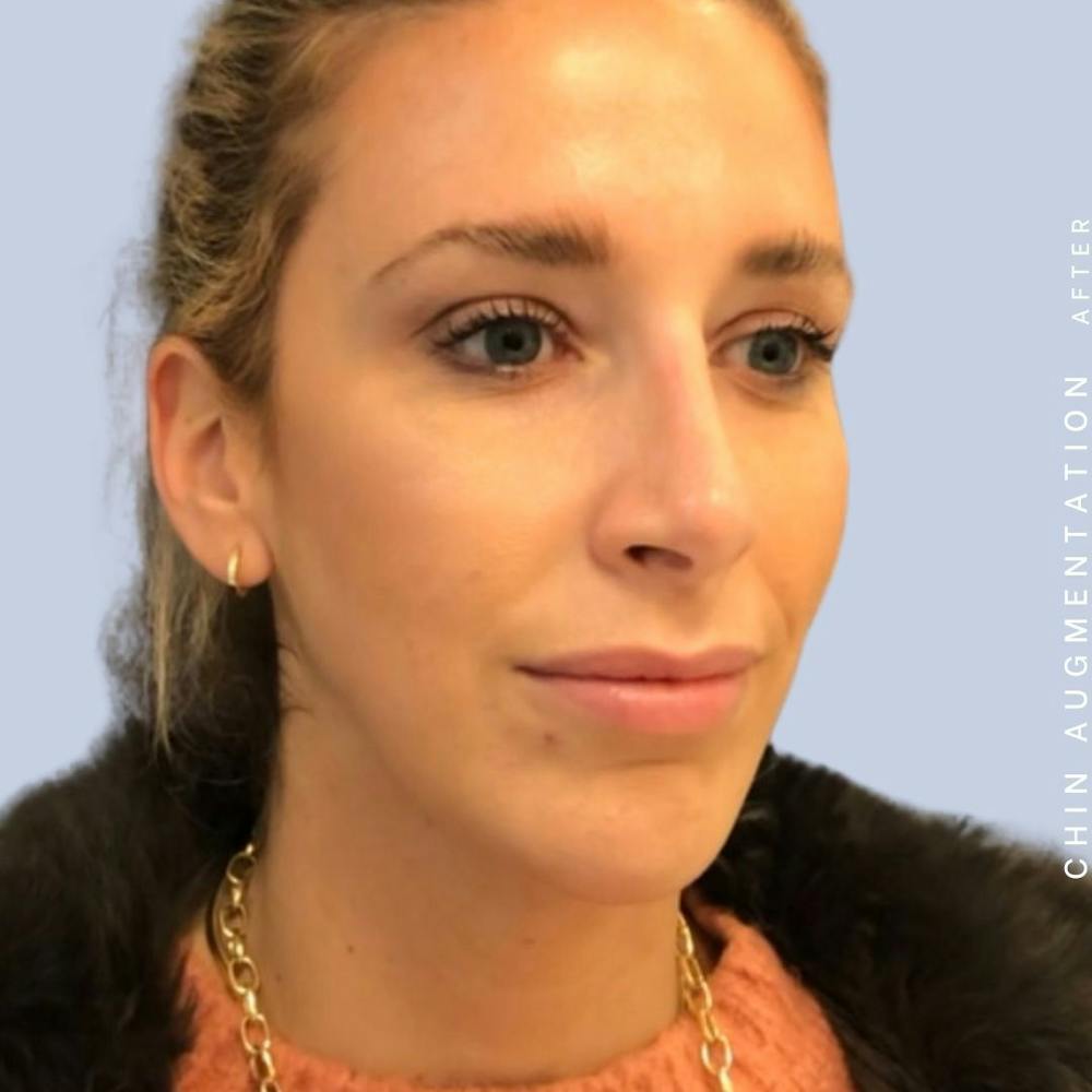Nose Before & After Gallery - Patient 108744867 - Image 8