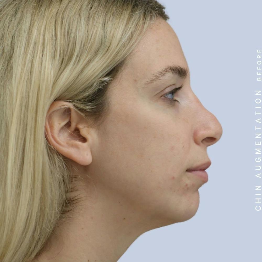 Non-Surgical Nose Before & After Gallery - Patient 108744867 - Image 9