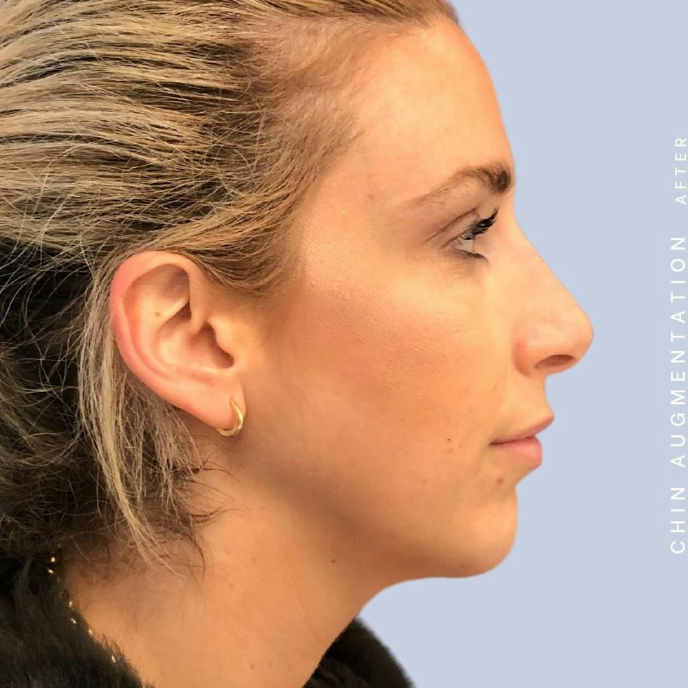 Nose Before & After Gallery - Patient 108744867 - Image 10