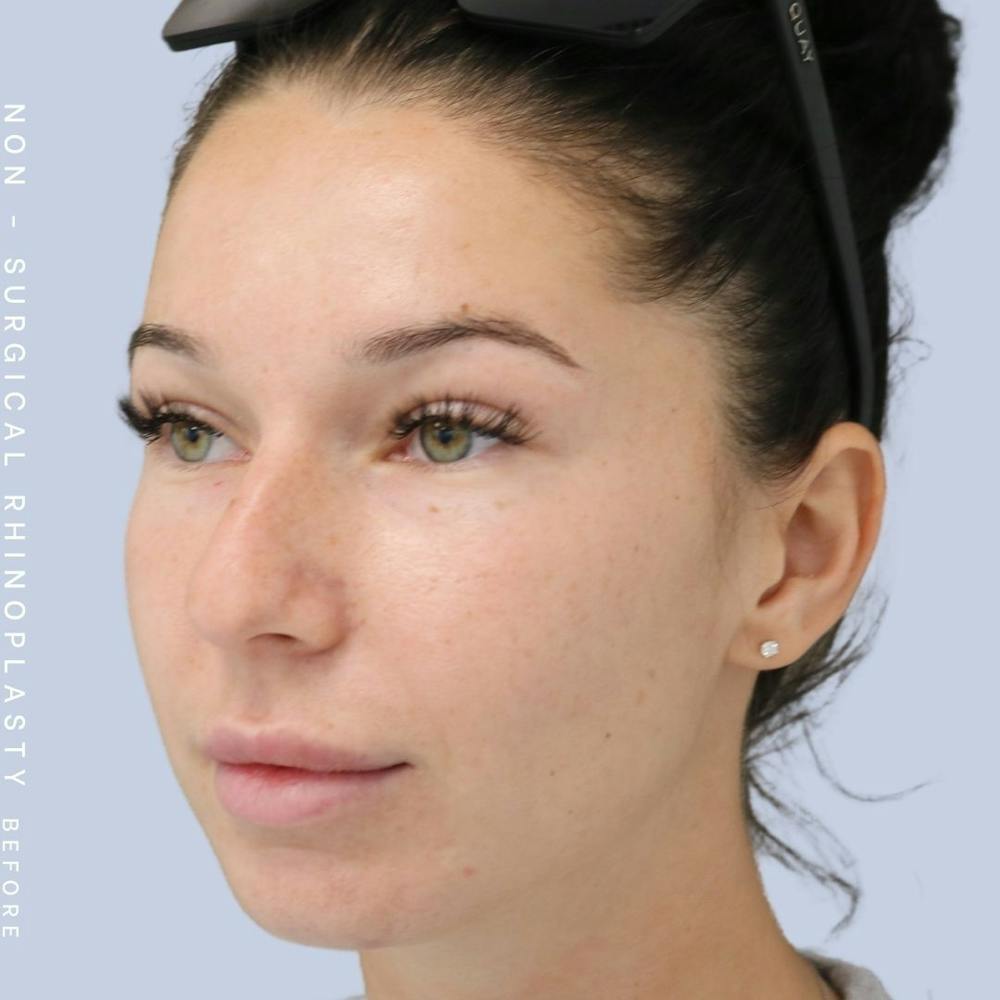 Non-Surgical Nose Before & After Gallery - Patient 108744868 - Image 1
