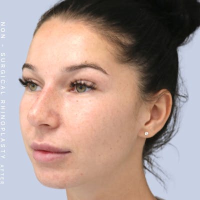 Non-Surgical Nose Before & After Gallery - Patient 108744868 - Image 2