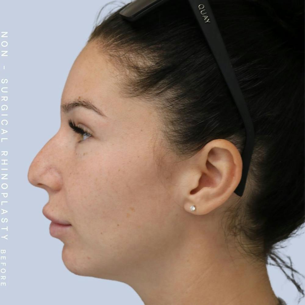 Non-Surgical Nose Before & After Gallery - Patient 108744868 - Image 3