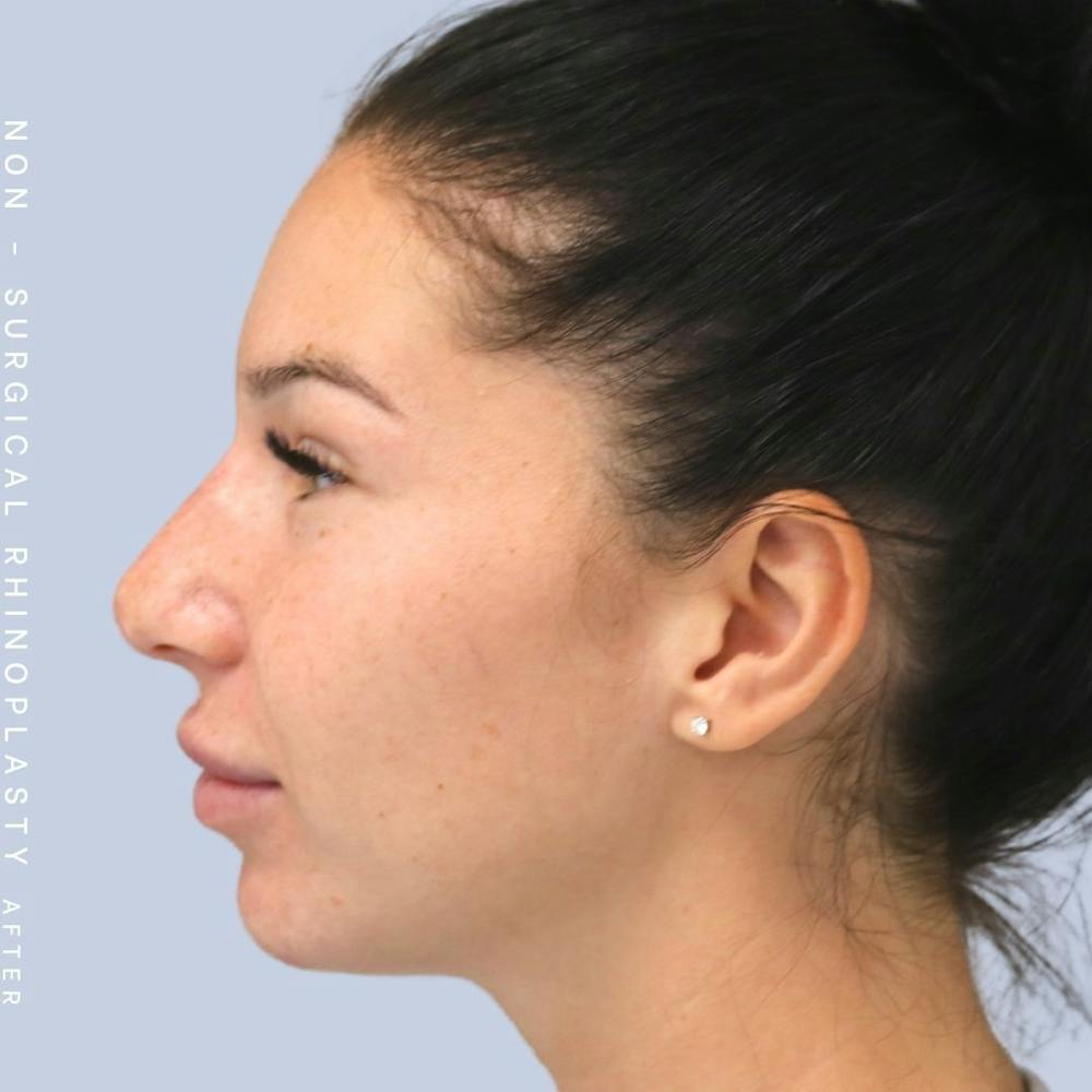 Non-Surgical Nose Before & After Gallery - Patient 108744868 - Image 4