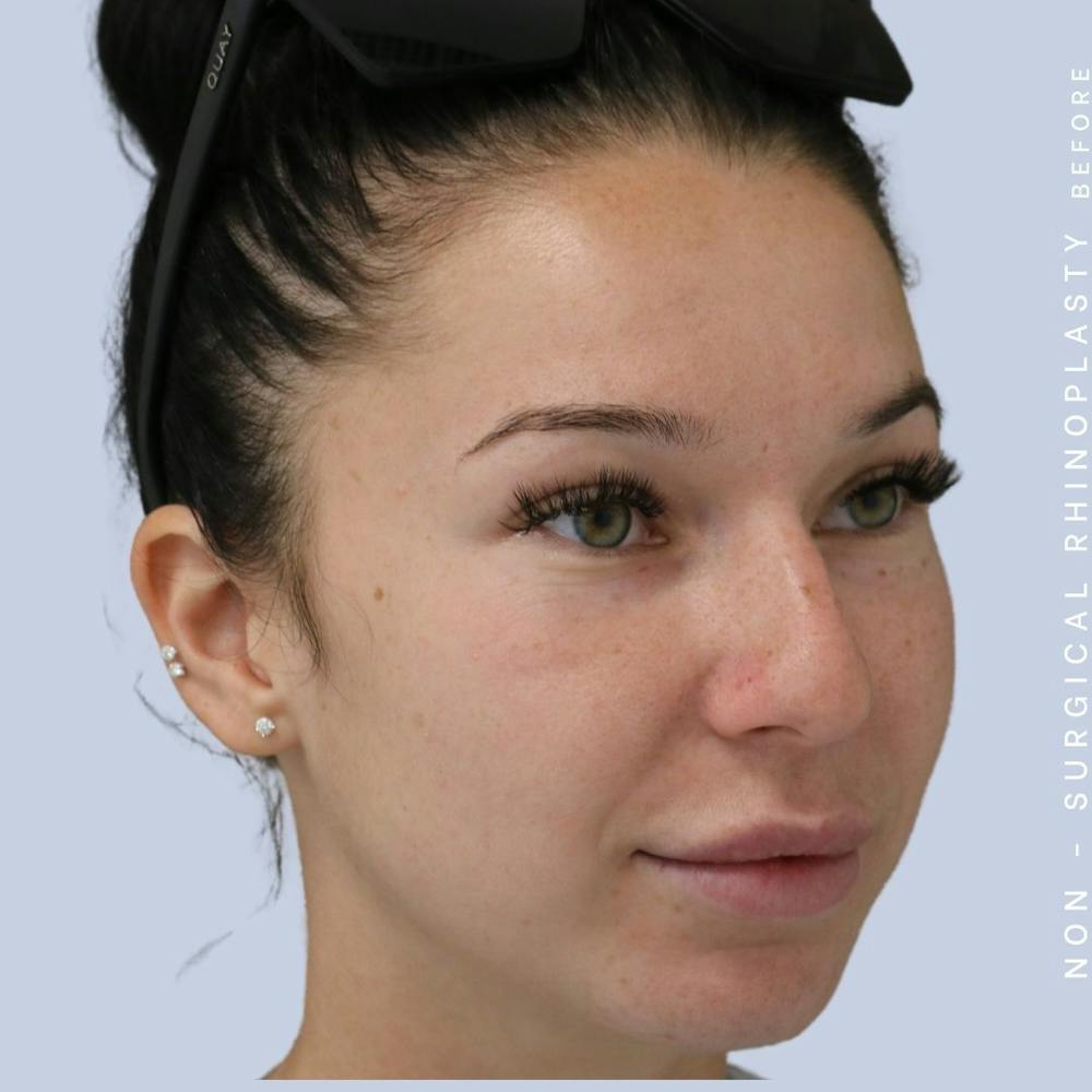 Non-Surgical Nose Before & After Gallery - Patient 108744868 - Image 5