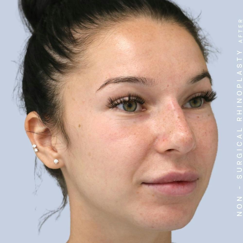 Non-Surgical Nose Before & After Gallery - Patient 108744868 - Image 6