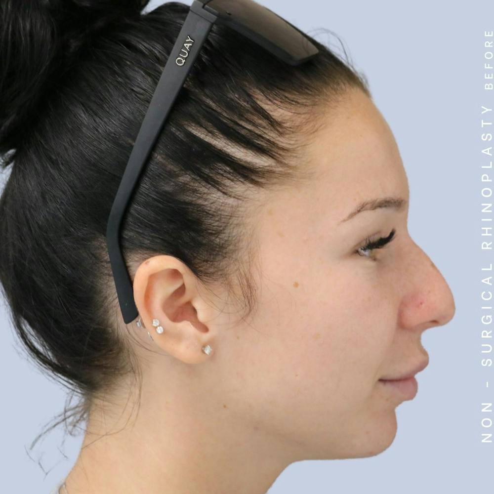 Non-Surgical Nose Before & After Gallery - Patient 108744868 - Image 7