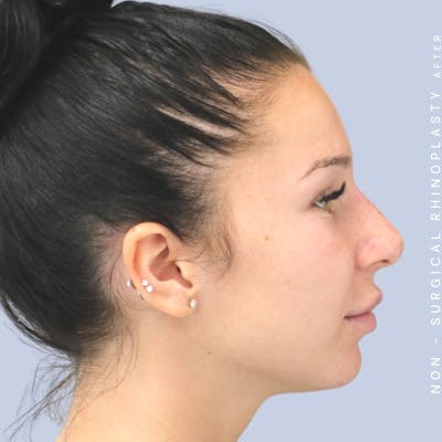 Non-Surgical Nose Before & After Gallery - Patient 108744868 - Image 8