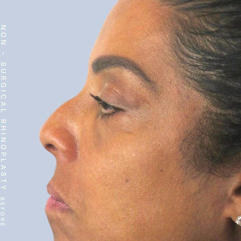 Non-Surgical Nose Before & After Gallery - Patient 108744869 - Image 1