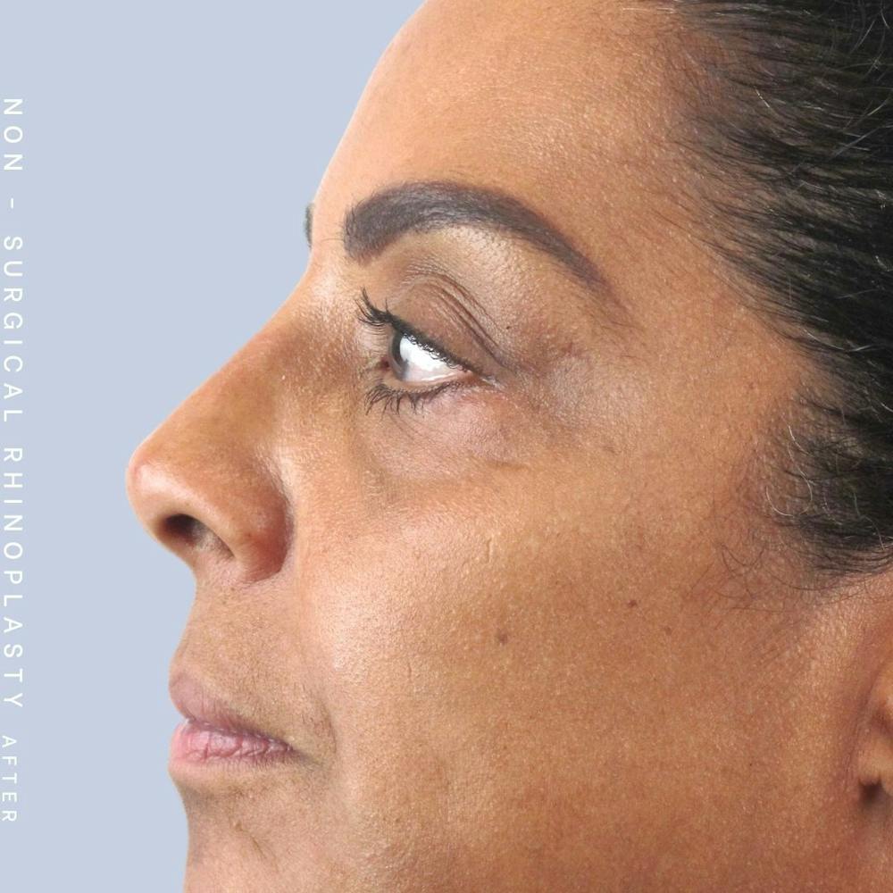 Non-Surgical Nose Before & After Gallery - Patient 108744869 - Image 2