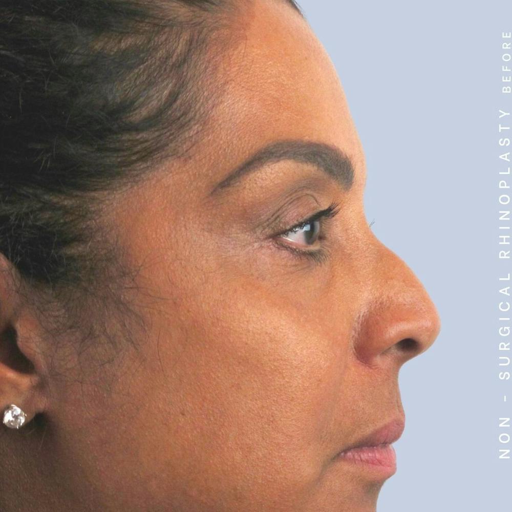 Non-Surgical Nose Before & After Gallery - Patient 108744869 - Image 3