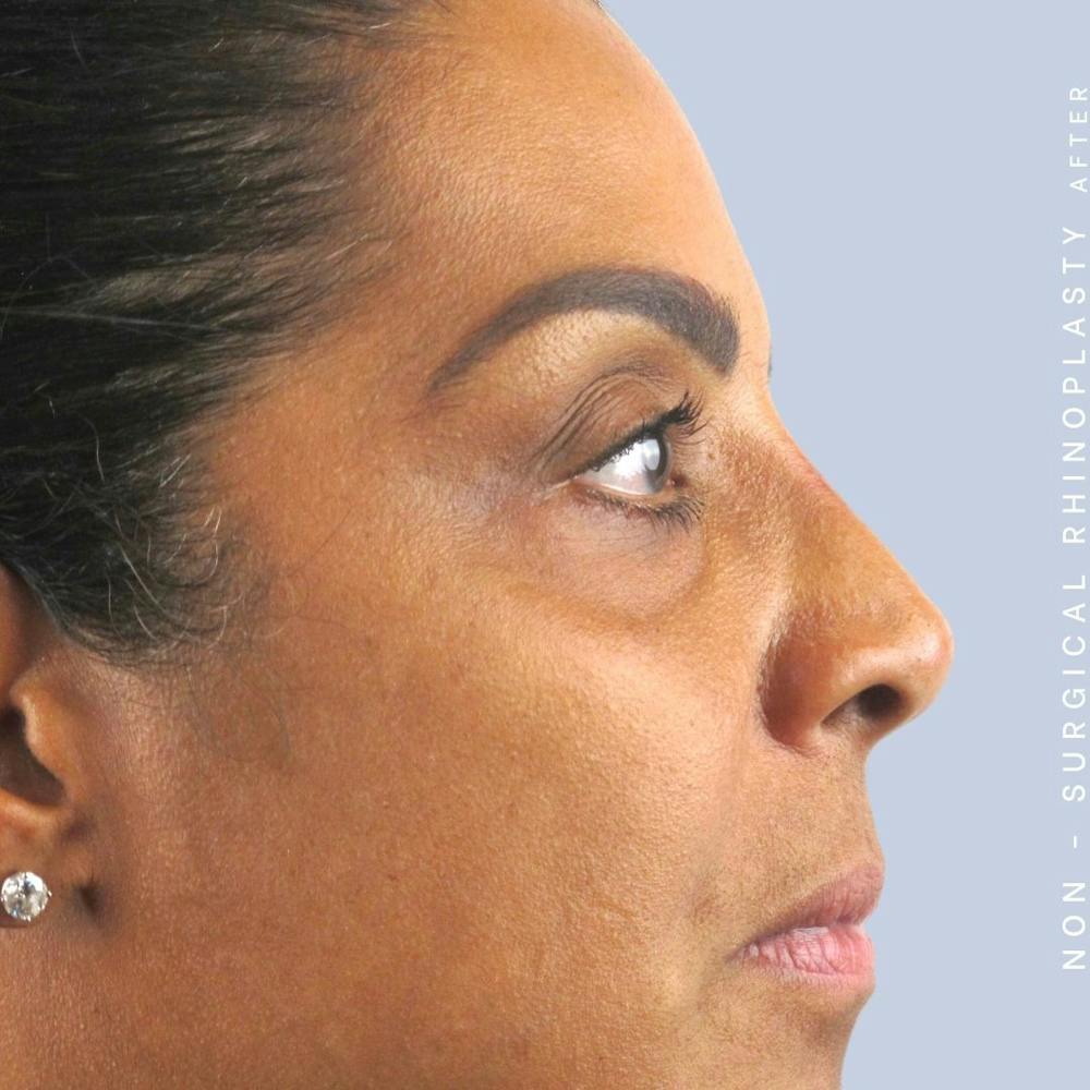 Non-Surgical Nose Before & After Gallery - Patient 108744869 - Image 4