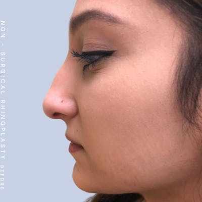 Nose Before & After Gallery - Patient 108744870 - Image 1
