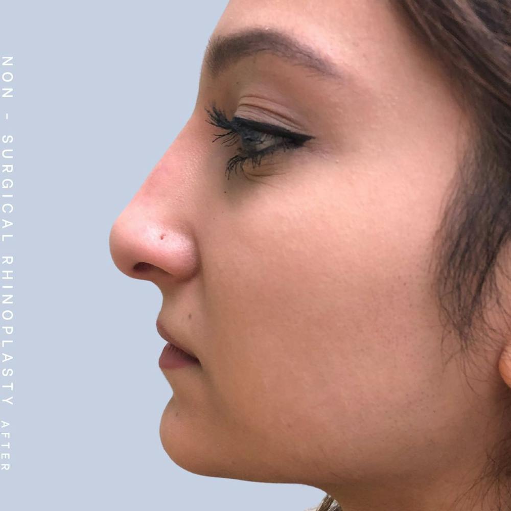 Non-Surgical Nose Before & After Gallery - Patient 108744870 - Image 2