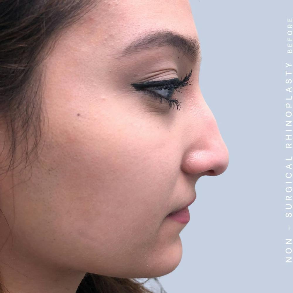 Non-Surgical Nose Before & After Gallery - Patient 108744870 - Image 3