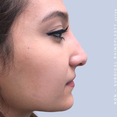 Non-Surgical Nose Before & After Gallery - Patient 108744870 - Image 4