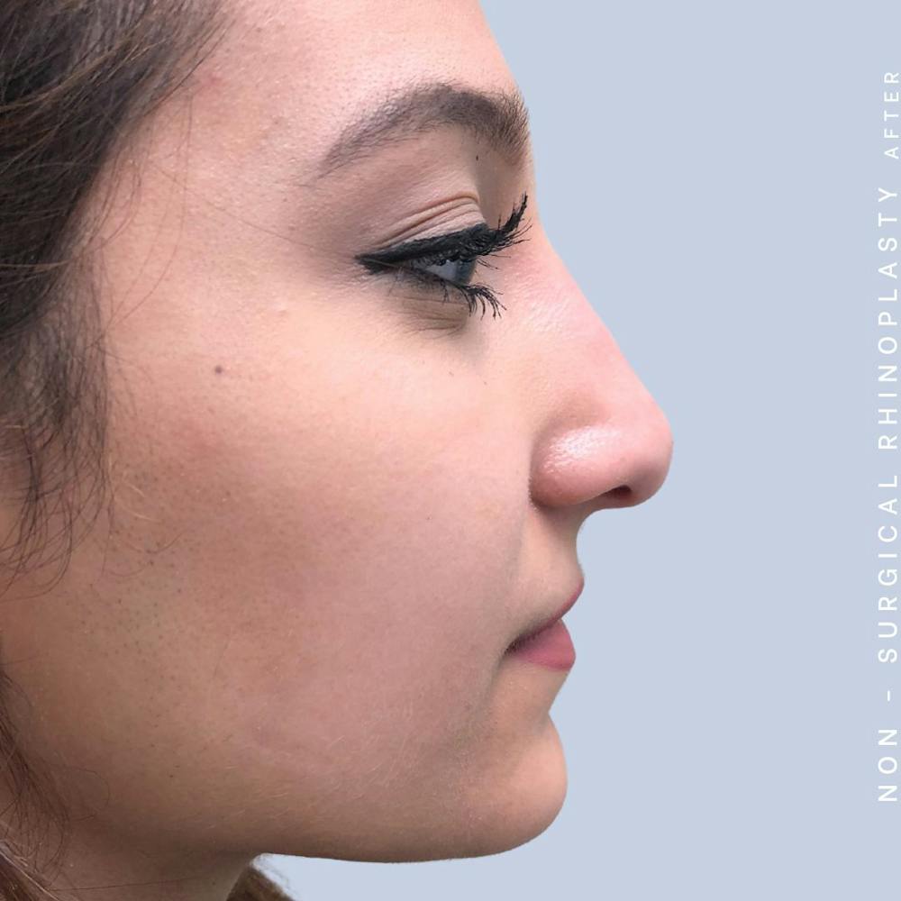 Non-Surgical Nose Before & After Gallery - Patient 108744870 - Image 4