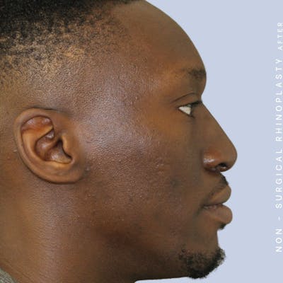 Non-Surgical Nose Before & After Gallery - Patient 108744871 - Image 4