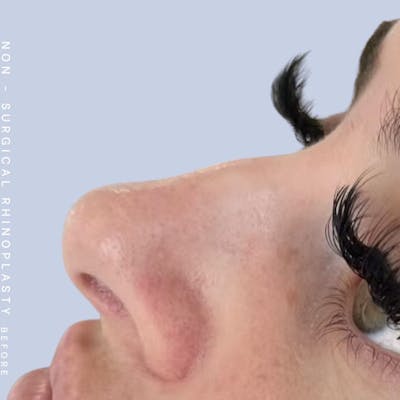 Nose Before & After Gallery - Patient 121563096 - Image 1