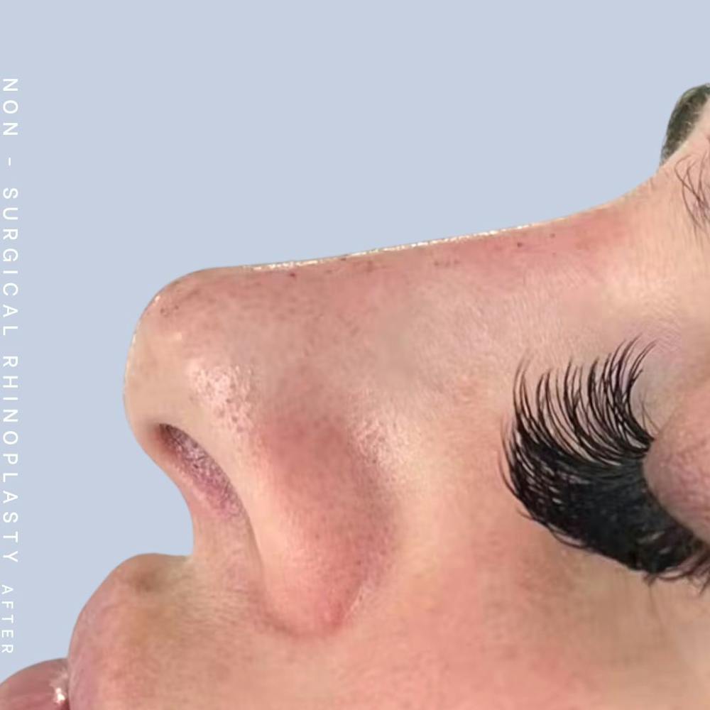 Non-Surgical Nose Before & After Gallery - Patient 121563096 - Image 2