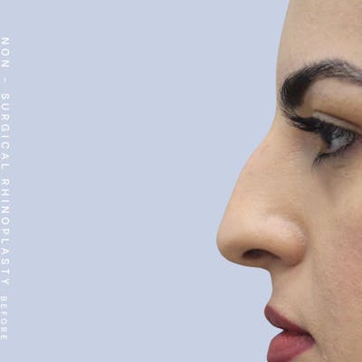 Nose Before & After Gallery - Patient 108744872 - Image 1