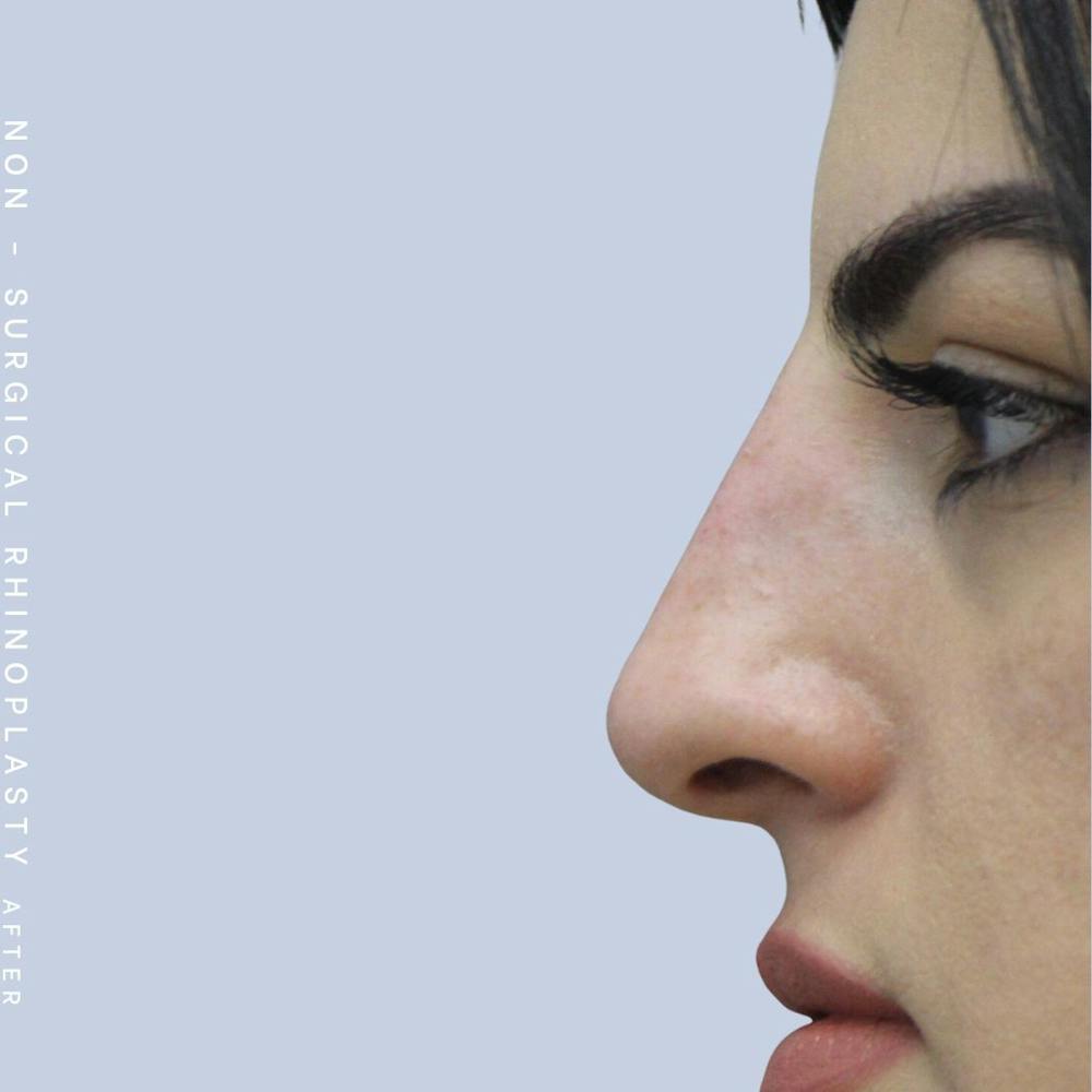 Nose Before & After Gallery - Patient 108744872 - Image 2