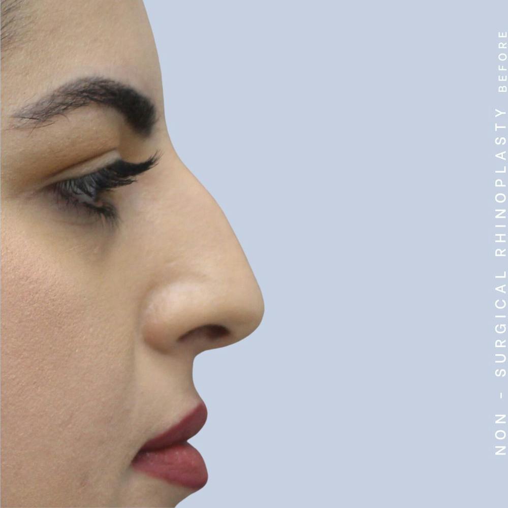 Nose Before & After Gallery - Patient 108744872 - Image 3