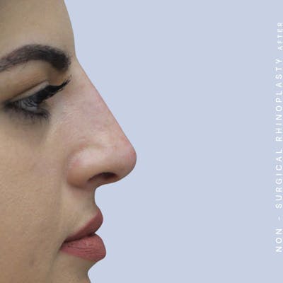 Nose Before & After Gallery - Patient 108744872 - Image 4