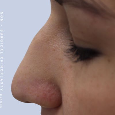 Nose Before & After Gallery - Patient 108744873 - Image 1