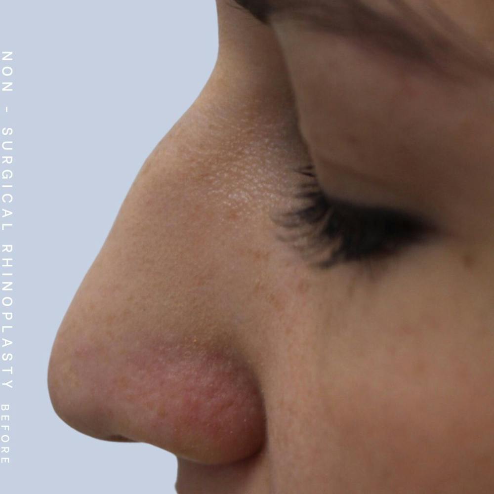 Non-Surgical Nose Before & After Gallery - Patient 108744873 - Image 1