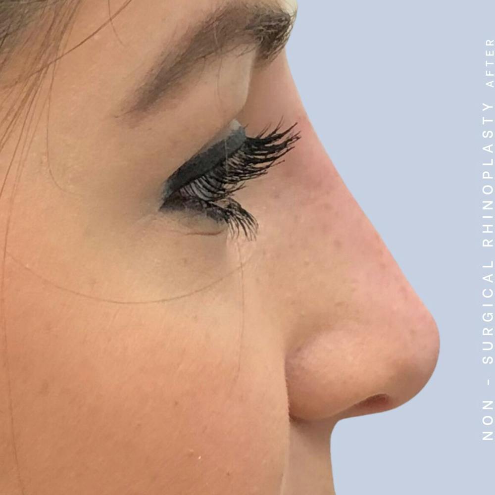 Non-Surgical Nose Before & After Gallery - Patient 108744873 - Image 4