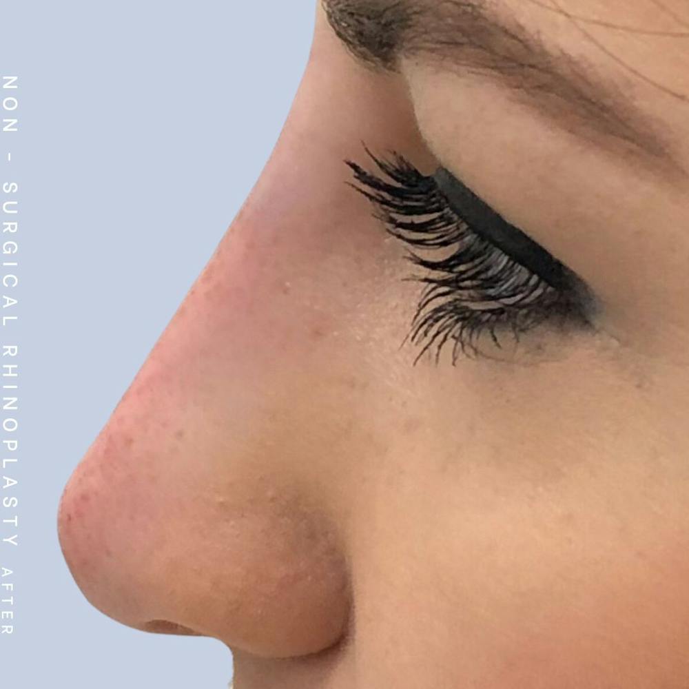Non-Surgical Nose Before & After Gallery - Patient 108744873 - Image 2