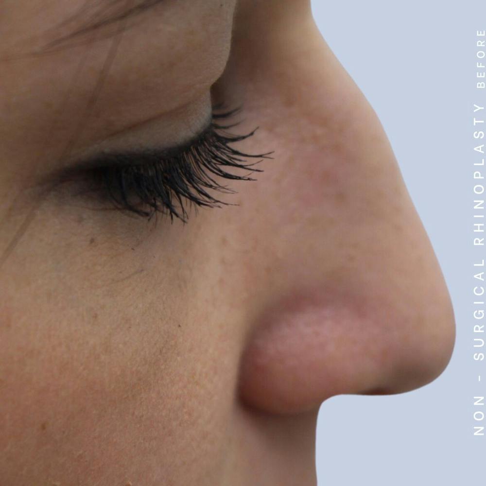 Non-Surgical Nose Before & After Gallery - Patient 108744873 - Image 3