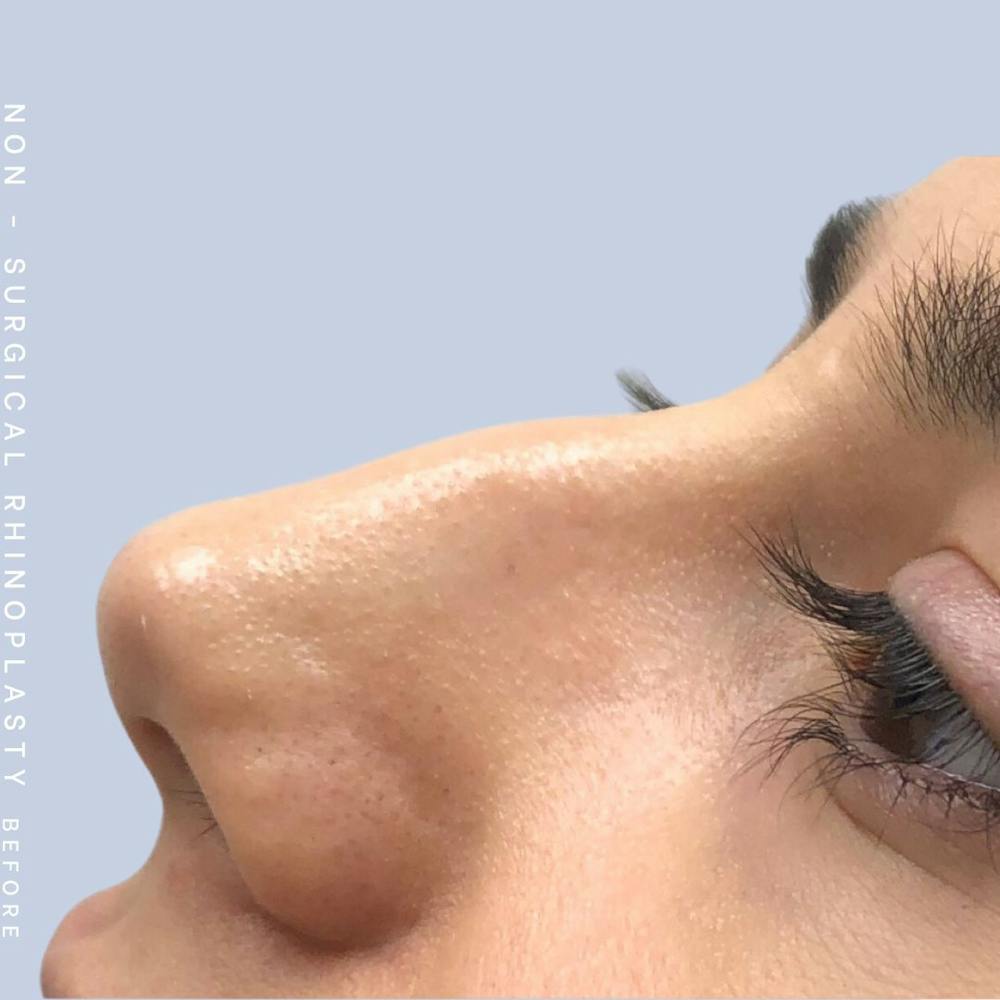 Non-Surgical Nose Before & After Gallery - Patient 108744874 - Image 1