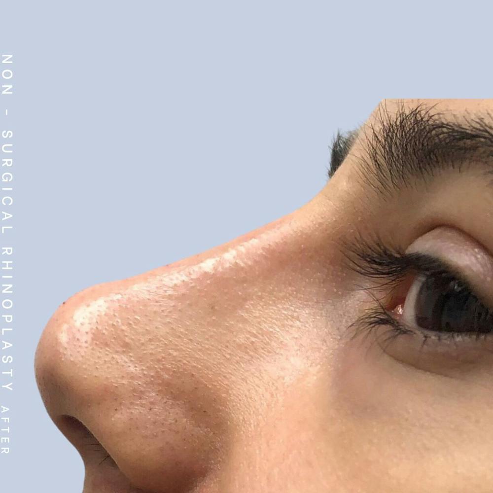 Non-Surgical Nose Before & After Gallery - Patient 108744874 - Image 2