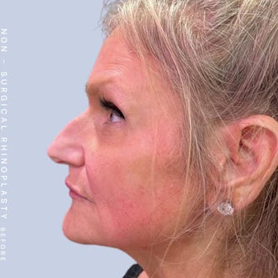 Non-Surgical Nose Before & After Gallery - Patient 120868474 - Image 1