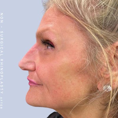 Non-Surgical Nose Before & After Gallery - Patient 120868474 - Image 2