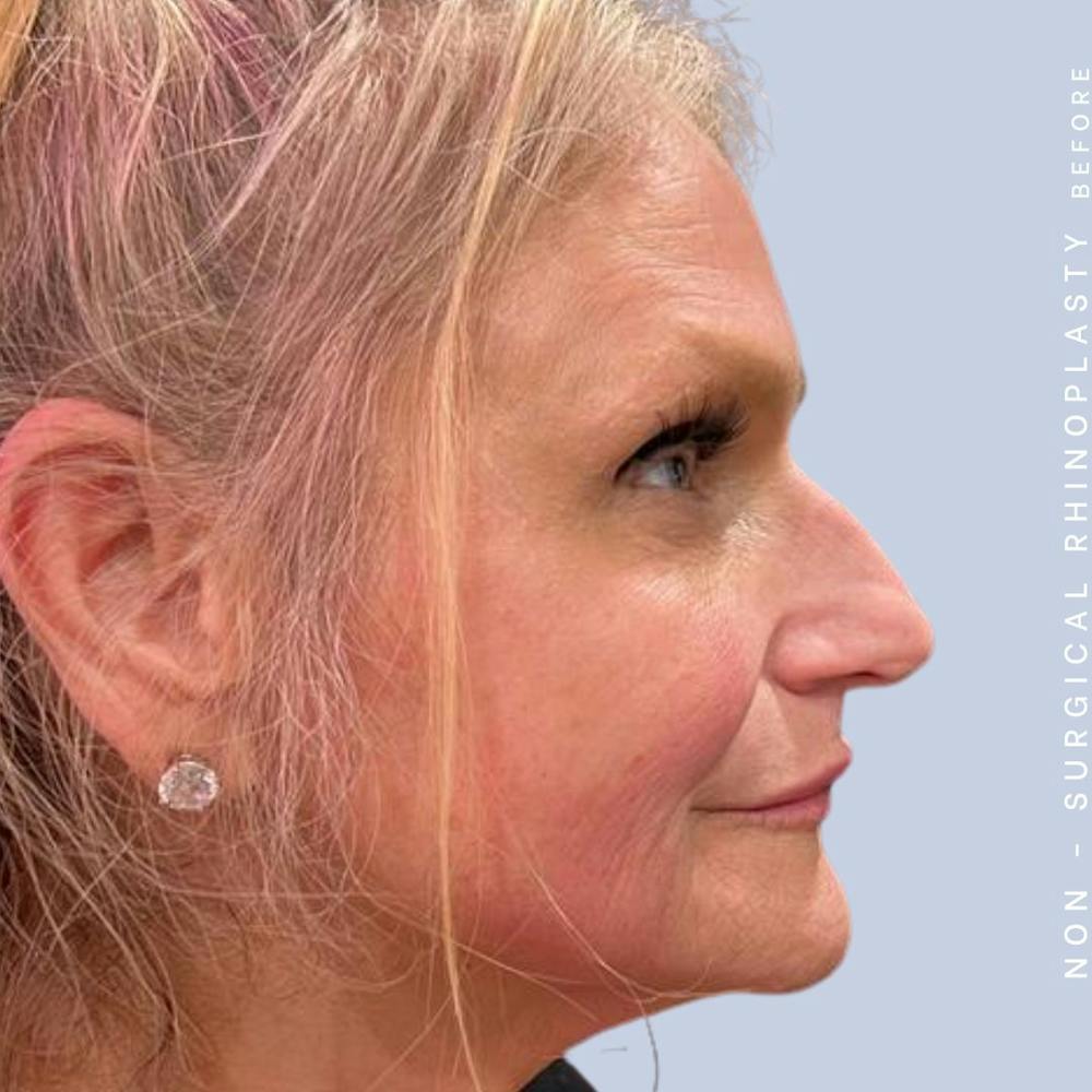 Non-Surgical Nose Before & After Gallery - Patient 120868474 - Image 3