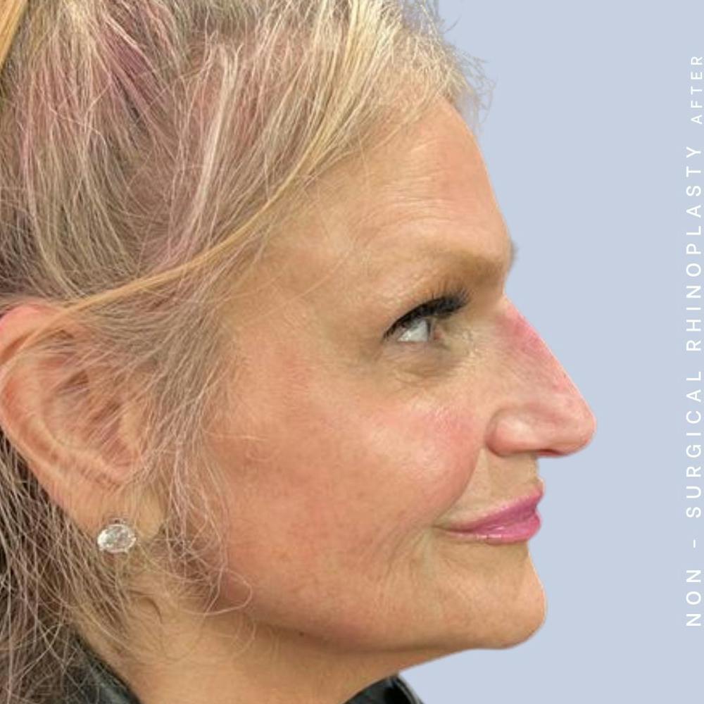Non-Surgical Nose Before & After Gallery - Patient 120868474 - Image 4