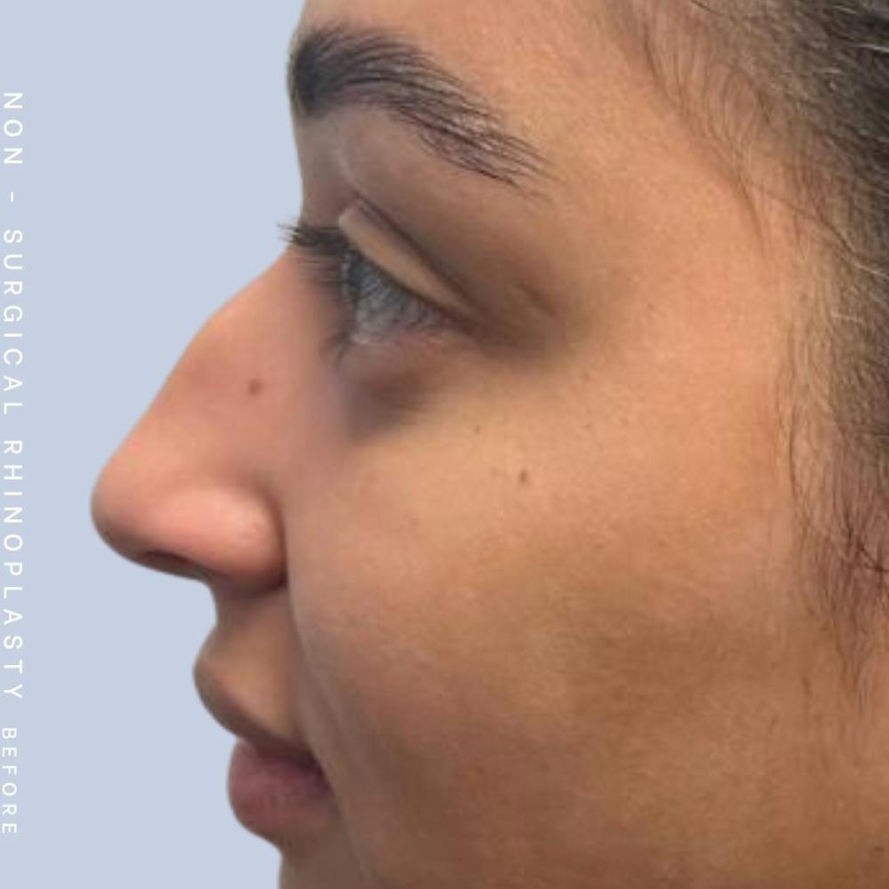 Non-Surgical Nose Before & After Gallery - Patient 122655465 - Image 1