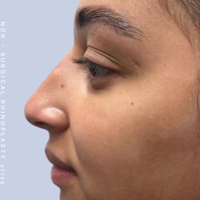 Non-Surgical Nose Before & After Gallery - Patient 122655465 - Image 2