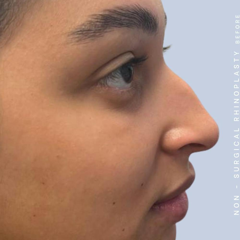 Non-Surgical Nose Before & After Gallery - Patient 122655465 - Image 3