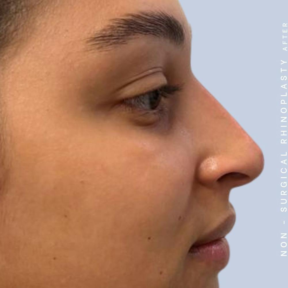 Non-Surgical Nose Before & After Gallery - Patient 122655465 - Image 4