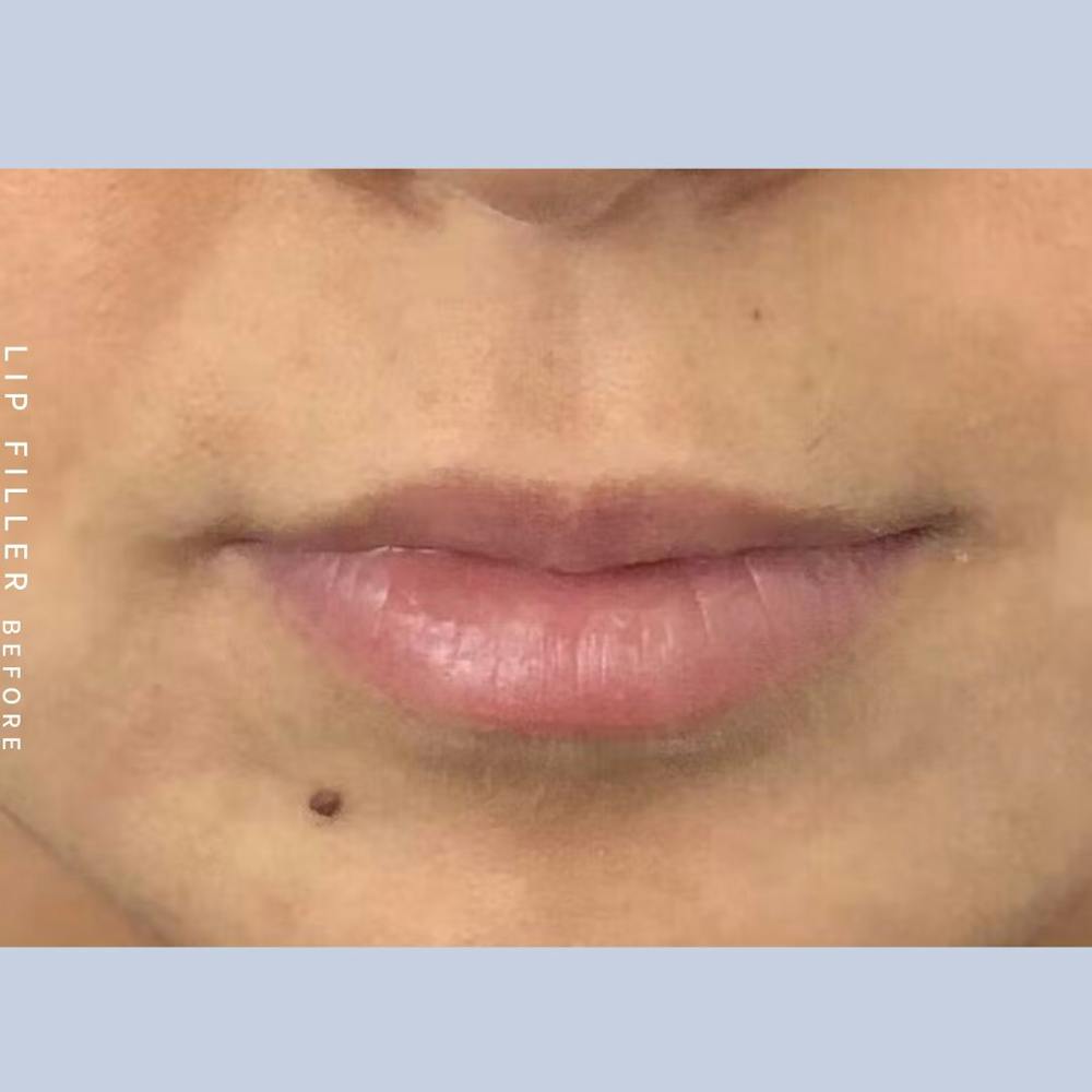 Lips Before & After Gallery - Patient 121418553 - Image 1